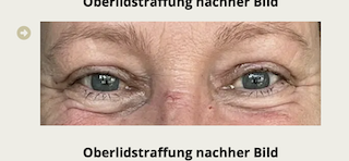 Oberlidstraffung Vorher-Nachher 2