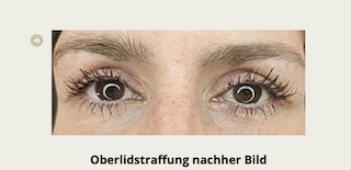 Oberlidstraffung Vorher-Nachher 4