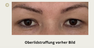 Oberlidstraffung Vorher-Nachher